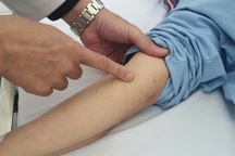 Tăng ca viêm màng não do não mô cầu, 82 người mắc trong 9 tháng