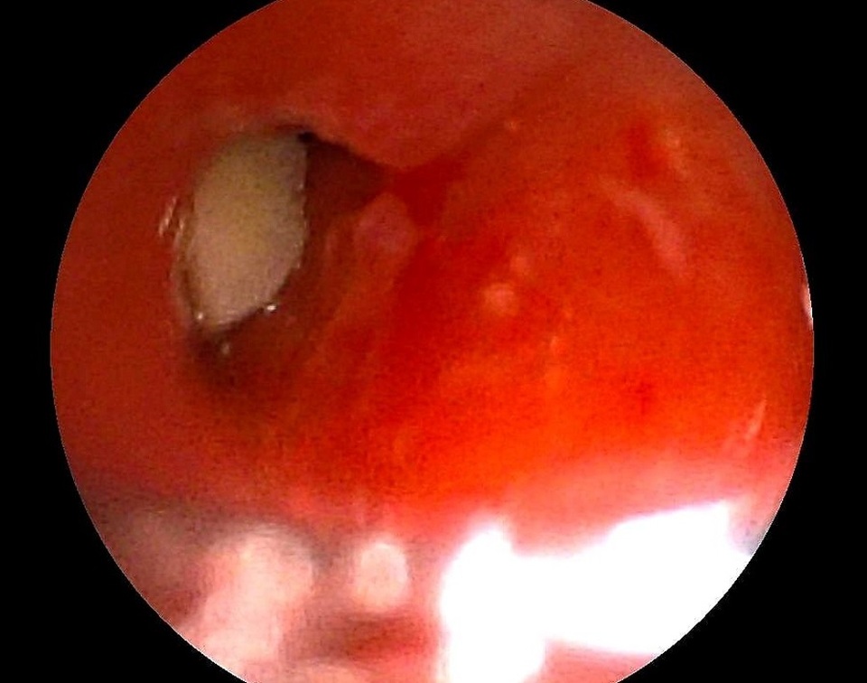 Trẻ bị viêm phổi kéo dài, coi chừng dị vật đường thở - 1 Trẻ bị viêm phổi kéo dài, coi chừng dị vật đường thở - 1