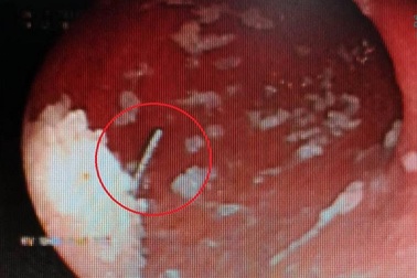 'Biểu diễn' không thành, kim may chui tọt vô bụng