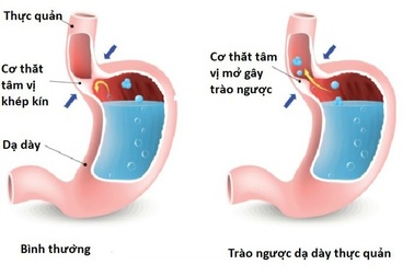 Mối liên hệ giữa ung thư thực quản và trào ngược axit?