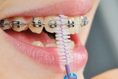 Sai lầm khi niềng răng nhiều người Việt mắc phải