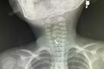 Nuốt phải kẹp tóc, bé gái 5 tuổi nhập viện cấp cứu