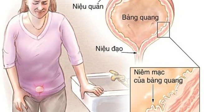 bang-quang-than-kinh-la-benh-gi-1