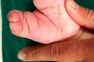 Bé trai có bàn tay, bàn chân như càng tôm hùm