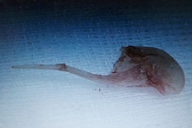 Bác sĩ “mò” không ra miếng xương cá ghim chặt vào phế quản