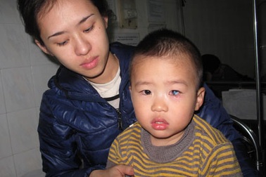 Nghịch gói chống ẩm, bé 2 tuổi bị bỏng mắt