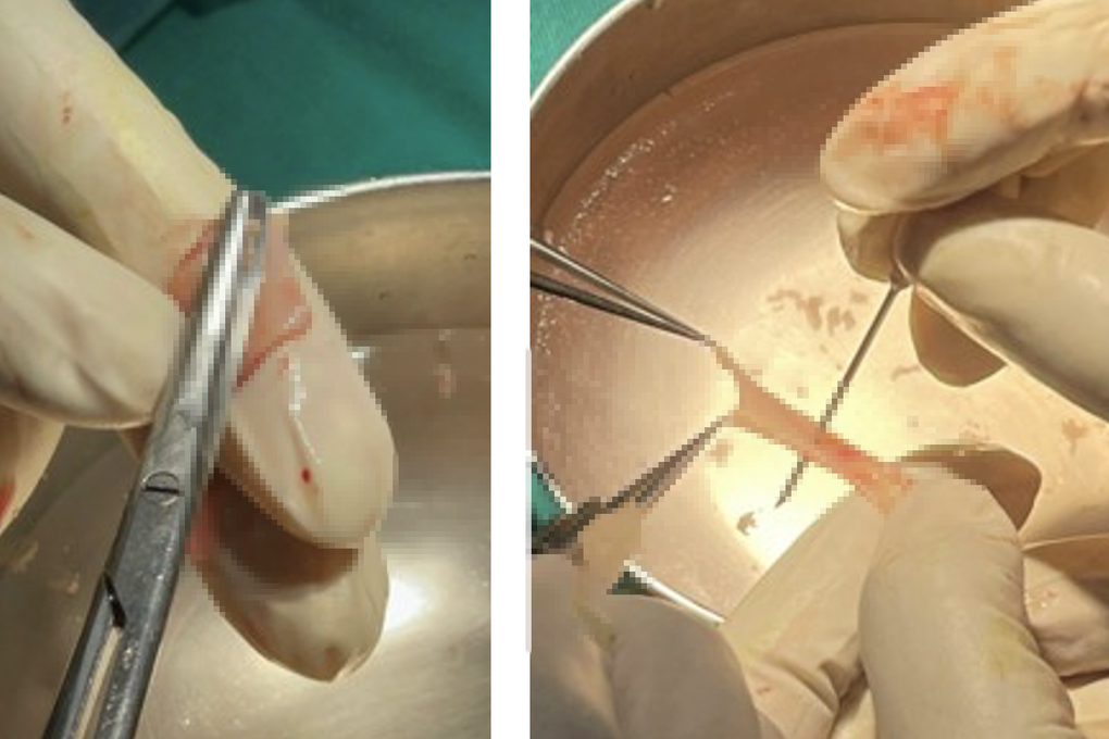 TPHCM: Bác sĩ dùng da trong miệng để... cứu đường tiểu chàng trai 29 tuổi - 2 TPHCM: Bác sĩ dùng da trong miệng để... cứu đường tiểu chàng trai 29 tuổi - 2