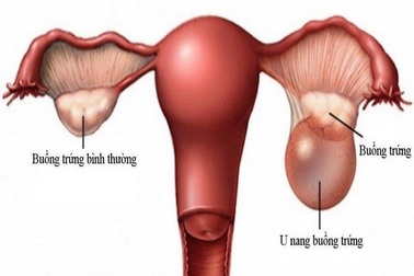 7 biểu hiện u nang buồng trứng
