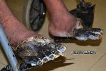 Kinh hoàng hai bàn chân người sống bỗng nhiên chết khô