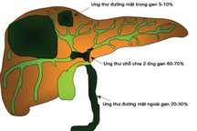 Ung thư đường mật: Chẩn đoán vô cùng khó khăn