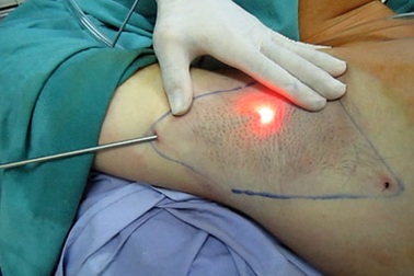 Khi nào nên cắt tuyến mồ hôi?