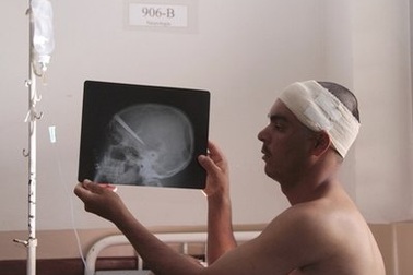 Lưỡi dao 10cm nằm gọn trong đầu 3 năm