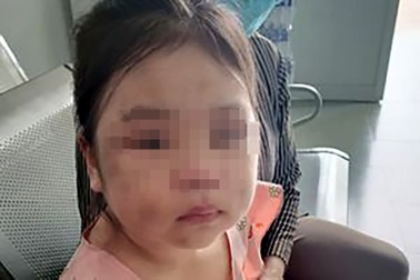 Bé gái 6 tuổi bị cha ruột đánh tím mắt khi kèm học online