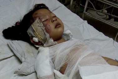 Vụ nổ hầm cầu: Người chồng đang nguy kịch, vợ con bỏng nặng