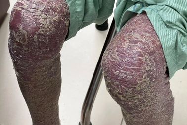 Hà Nội: Người đàn ông có "da rắn" vì căn bệnh thường gặp