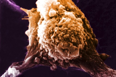 Khoẻ mạnh với 26 khối u ác tính trong bụng