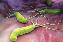 Trẻ em cũng có thể mắc ung thư dạ dày