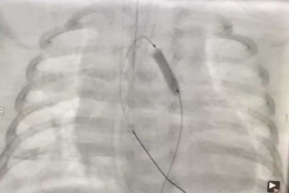 Can thiệp cứu thành công bệnh nhi 44 ngày tuổi tim bẩm sinh hiếm gặp - 1