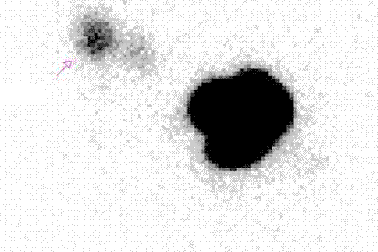 Phù “tay voi” sau nạo vét hạch ung thư vú 