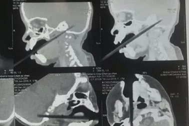 Bị đũa xuyên qua não, bé 17 tháng tuổi thoát chết thần kỳ