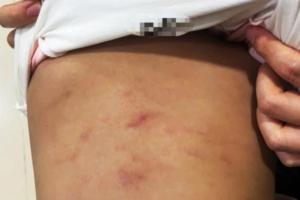 2 år gammel jente viser tegn på mishandling i privat barnehage - 1 Bé gái 2 tuổi có dấu hiệu bị bạo hành ở nhóm trẻ tư thục - 1