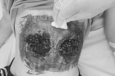 Cô gái bỏng nặng vì giác hơi bụng để... chữa ung thư