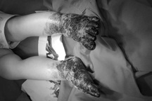 2 bàn chân bé trai sưng nề, chảy dịch đục chỉ vì sai lầm của người lớn