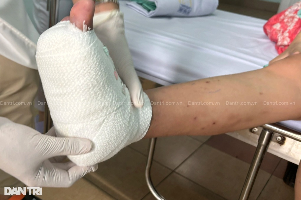 Cô gái ở TPHCM hoại tử khi ngâm nước nóng, đi 4 bệnh viện vẫn mất ngón chân - 2 Cô gái ở TPHCM hoại tử khi ngâm nước nóng, đi 4 bệnh viện vẫn mất ngón chân - 2