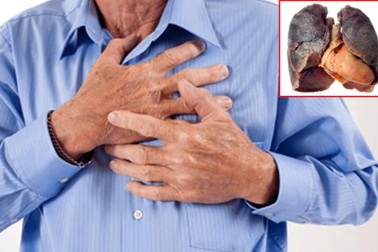 Điều trị như thế nào khi mắc 2 bệnh ung thư một lúc?