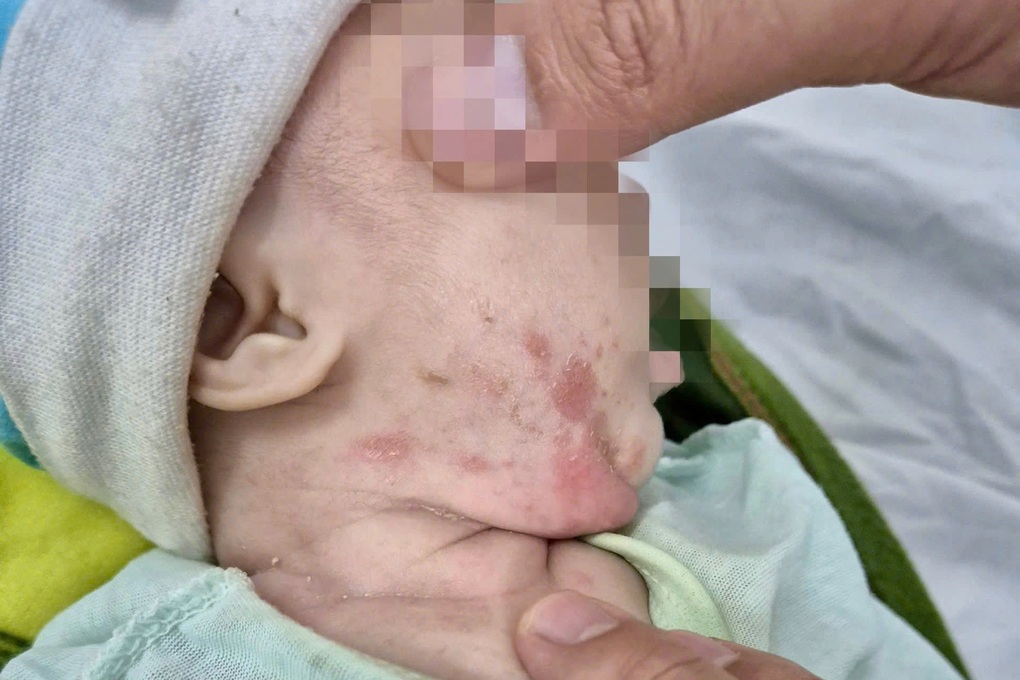 Con 2 tháng tuổi mắc giang mai, bố mẹ tưởng bị viêm da - 1 Con 2 tháng tuổi mắc giang mai, bố mẹ tưởng bị viêm da - 1