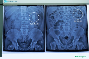 Thách thức tán sỏi san hô khổng lồ cho bệnh nhân hậu tai biến