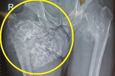 Choáng khối u xương chuyển thành ác tính phì đại như cây súp lơ khổng lồ