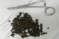 Mổ ở Mỹ thất bại, nữ Việt kiều được bác sĩ tại TPHCM lấy 481 viên sỏi mật