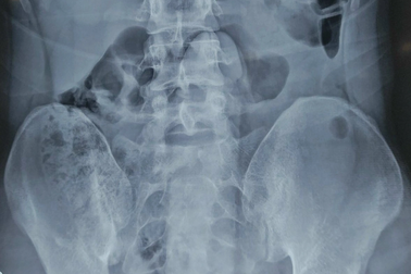 TPHCM: Cấp cứu nam thanh niên bị kẹt dương vật giả dài 25cm trong vùng kín