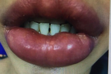 Giật mình hình ảnh đôi môi sưng phồng của người phụ nữ do tiêm filler làm đẹp