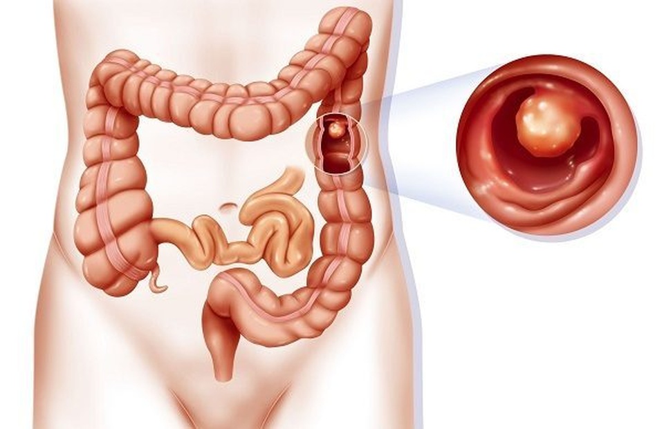 Khi nào nên bắt đầu khám sàng lọc ung thư đại trực tràng? - 1 Khi nào nên bắt đầu khám sàng lọc ung thư đại trực tràng? - 1