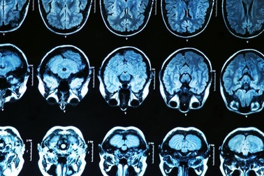 Loãng xương có thể liên quan đến bệnh Alzheimer