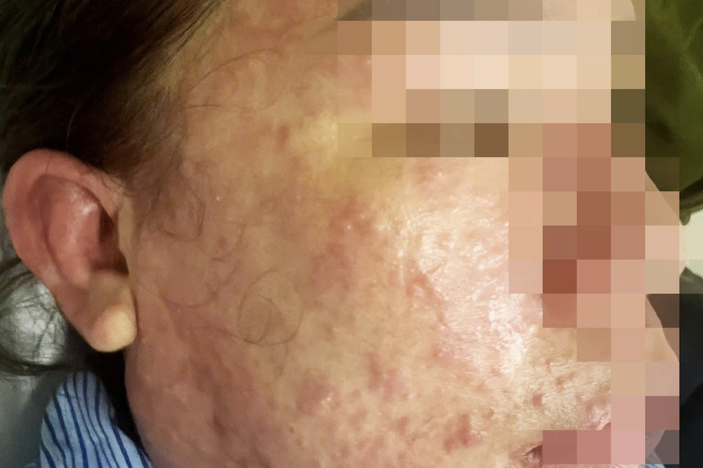 Dùng “thuốc giảm mỡ bụng, collagen”, người phụ nữ nguy kịch - 1 Dùng “thuốc giảm mỡ bụng, collagen”, người phụ nữ nguy kịch - 1
