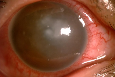 Loét giác mạc vì nhiễm ký sinh trùng trong bụi