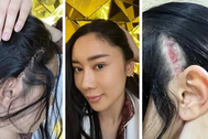 Hoa hậu Thái Lan gây sốc khi công khai ảnh chụp vết sẹo lớn sau thẩm mỹ