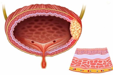 Bí tiểu, khó tiểu - dấu hiệu sớm cảnh báo ung thư bàng quang