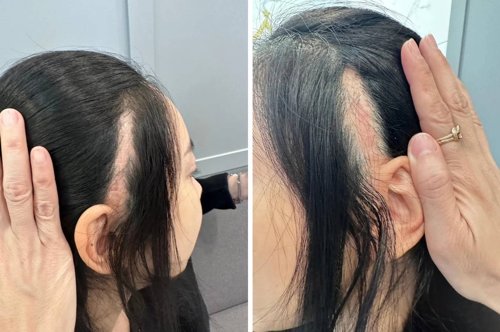 Hoa hậu Thái Lan gây sốc khi công khai ảnh chụp vết sẹo lớn sau thẩm mỹ - 2 Hoa hậu Thái Lan gây sốc khi công khai ảnh chụp vết sẹo lớn sau thẩm mỹ - 2