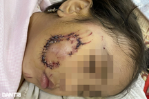 Nô đùa với chó con, bé gái 5 tuổi bị chó mẹ cắn rách mặt