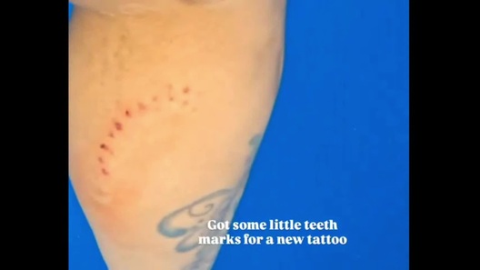 Cô gái bị cá mập cắn khi đang lặn biển