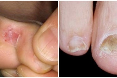 Nấm da - Kẻ thù của dân thể thao