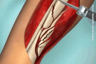 Xem cách mà y học hiện đại phục hồi một chiếc chân có xương bị gãy vụn!