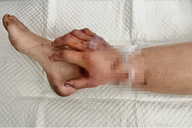 Thai phụ được ghép tạm tay đứt lìa vào chân đã thực hiện ca mổ "định mệnh"