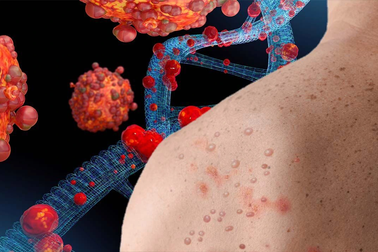 Triệu chứng của bệnh đậu mùa khỉ, cách phòng tránh