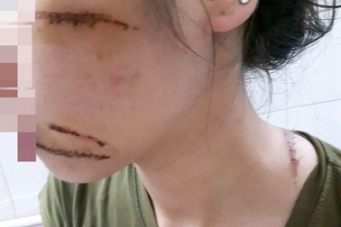 Nữ nhân viên spa bị côn đồ chém trọng thương