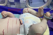 Mắc bệnh da vảy cá hiếm gặp, bé trai chào đời với cơ thể nứt nẻ, rớm máu